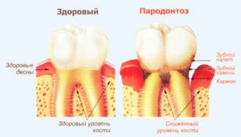 Пародонтоз